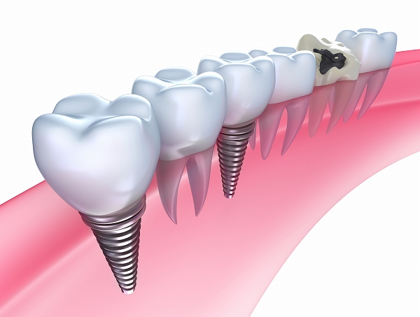 インプラント・ブリッジ・入れ歯と、歯を失ってしまった時の治療方法には選択肢があります