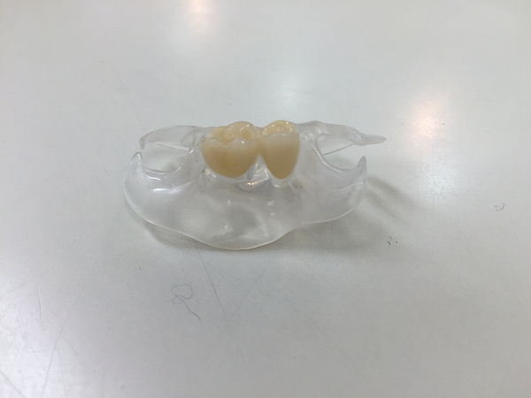 ノンクラスプデンチャー